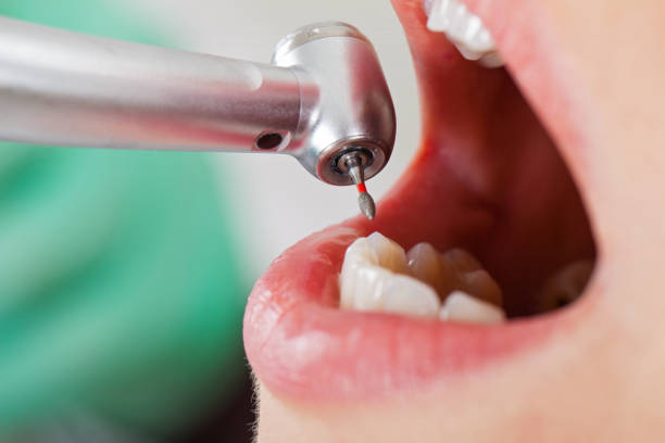 Best Emergency Dental Extractions in Largo, MD